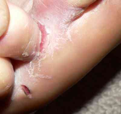 Close up of athlete's foot between the toes showing peeling skin