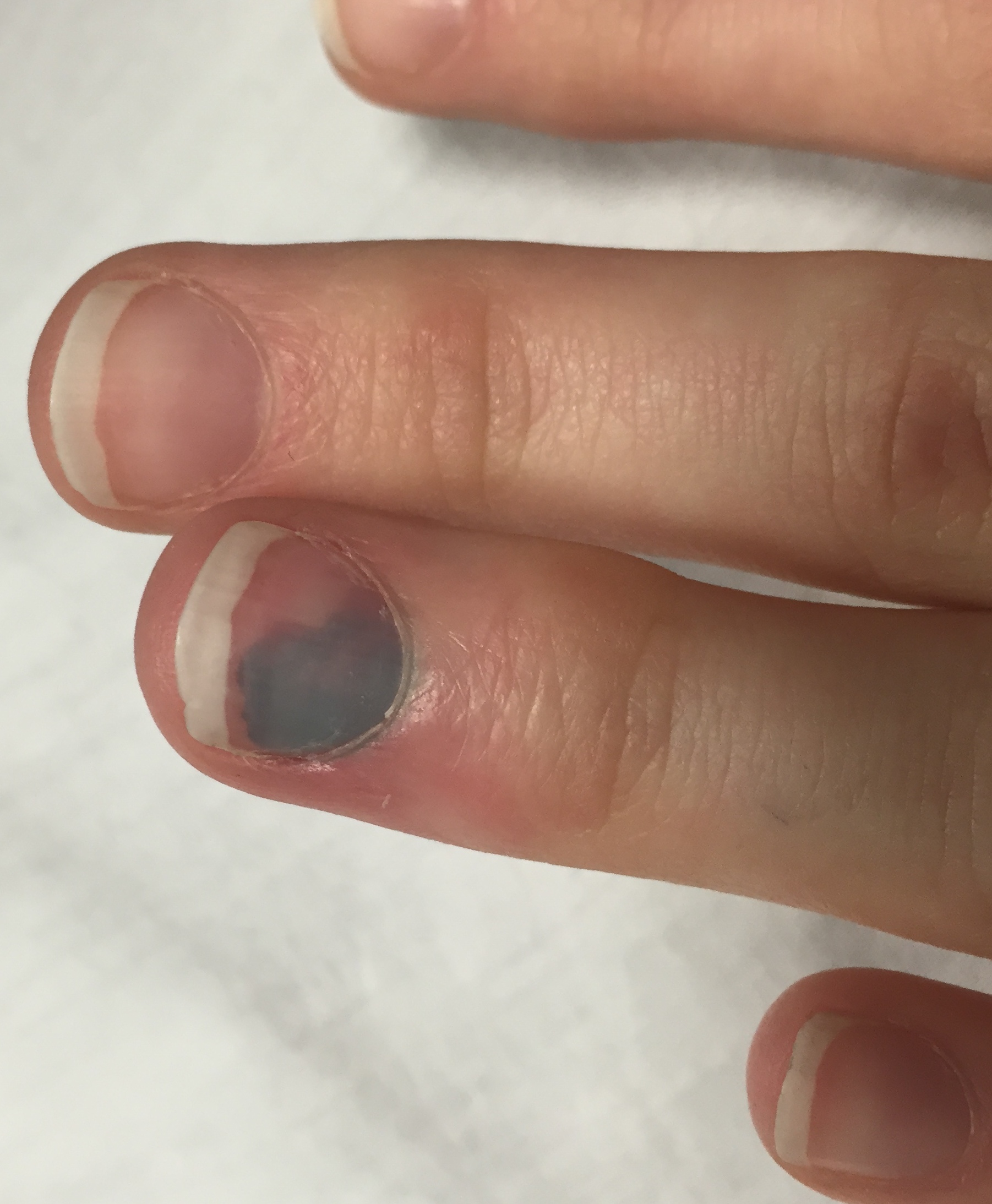 A close view of a dark nail caused by bleeding under the nail