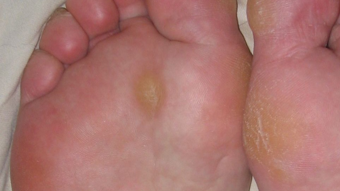A real photo showing thickened callus skin under the ball of the foot