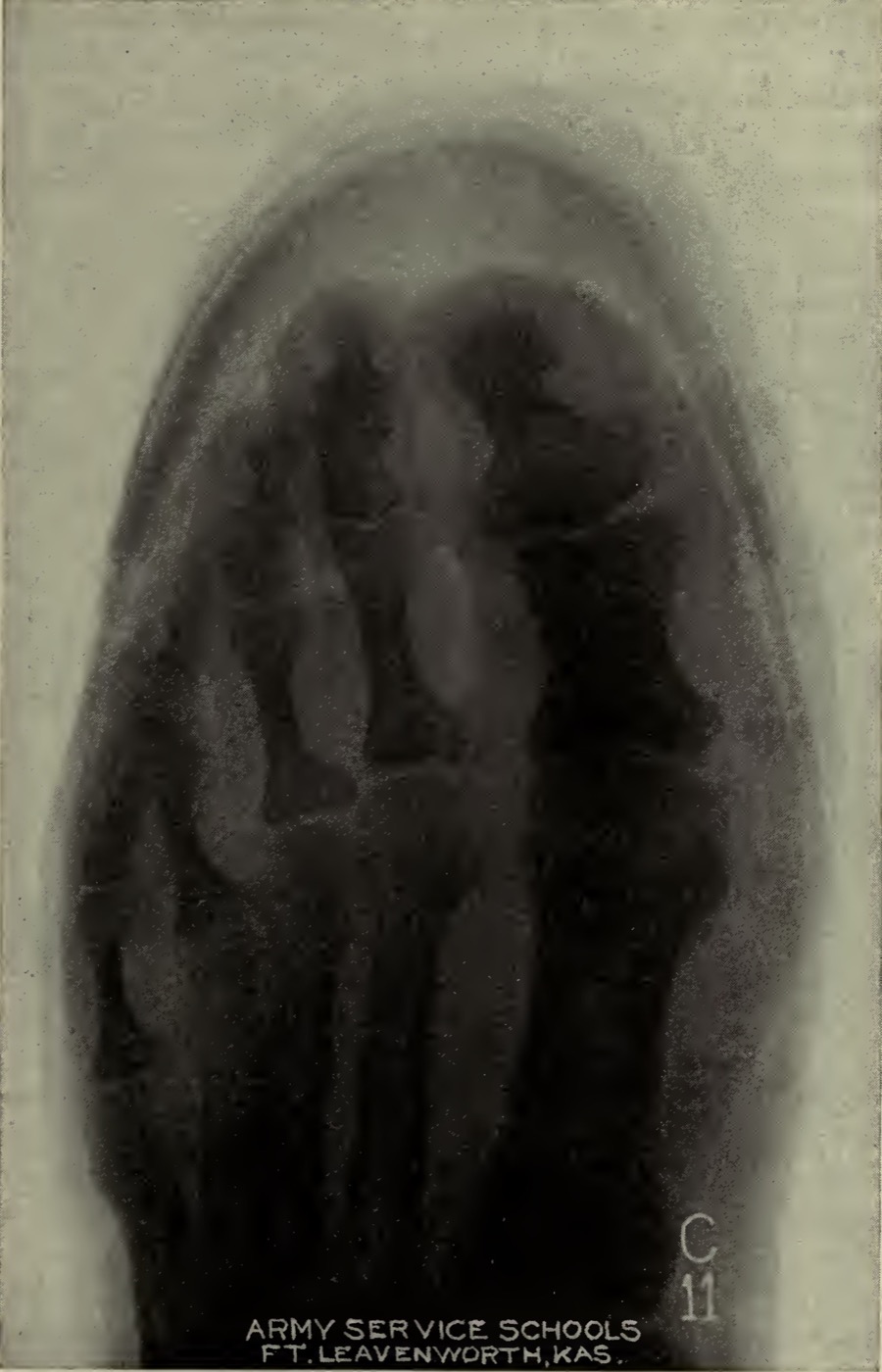 Historic shoe fitting image showing toe pressure and shoe shape