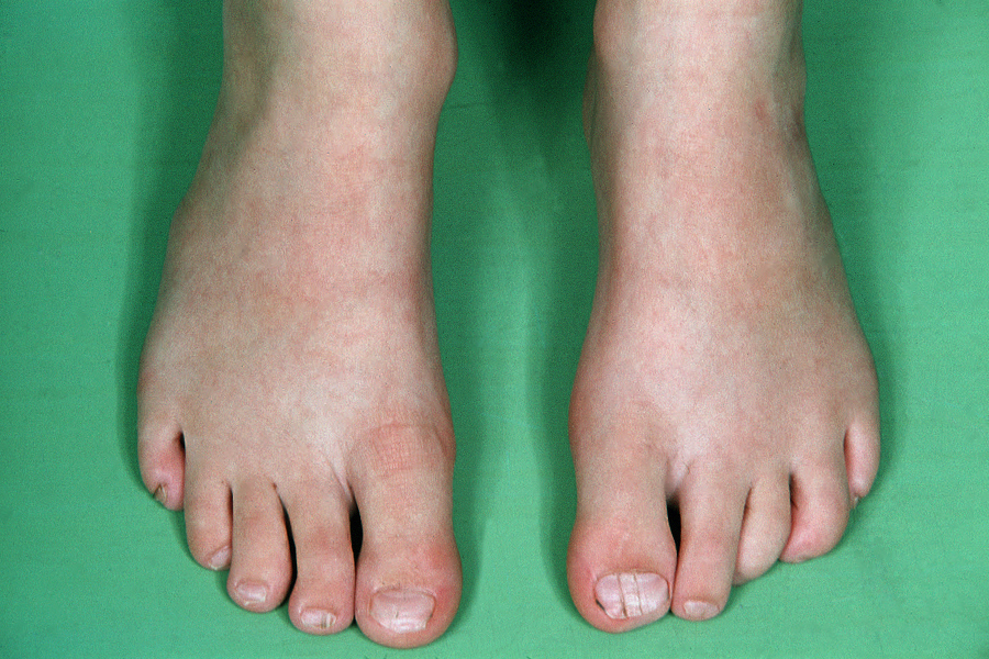 Close view of a thickened toenail