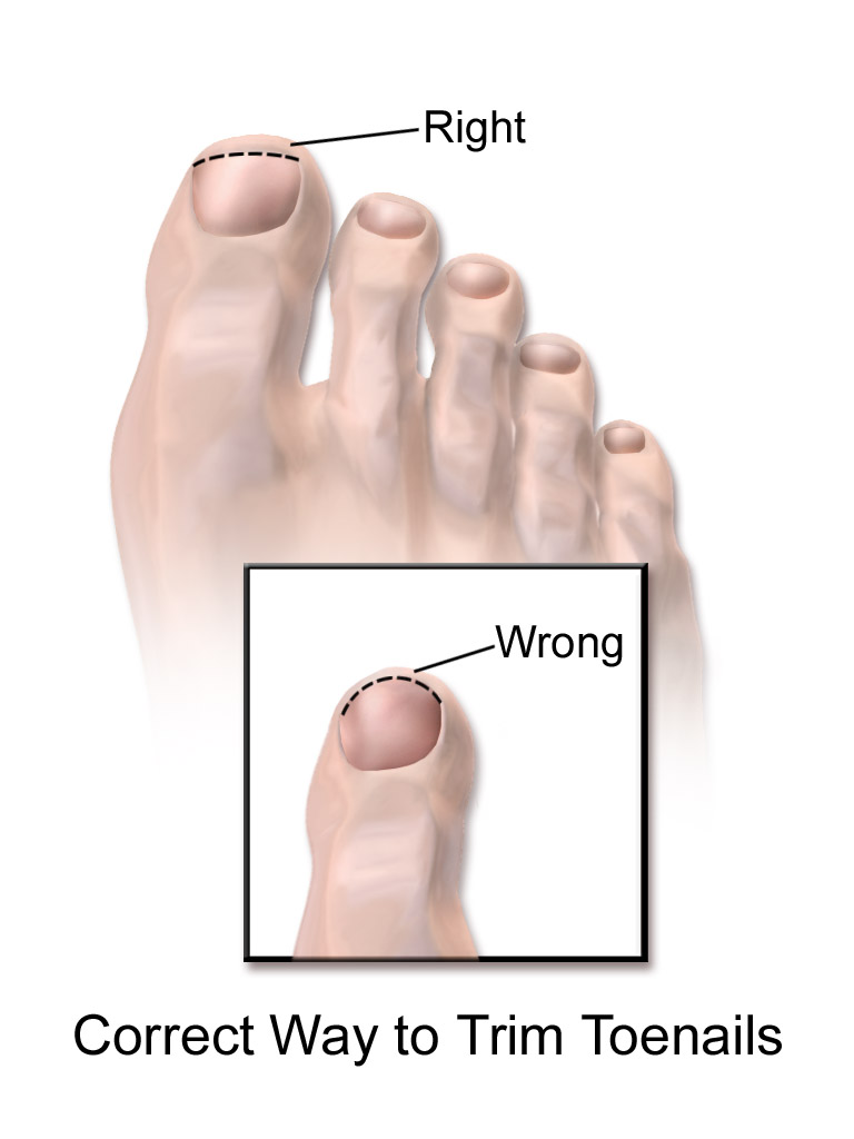 Illustration showing trimming toenails as part of routine care