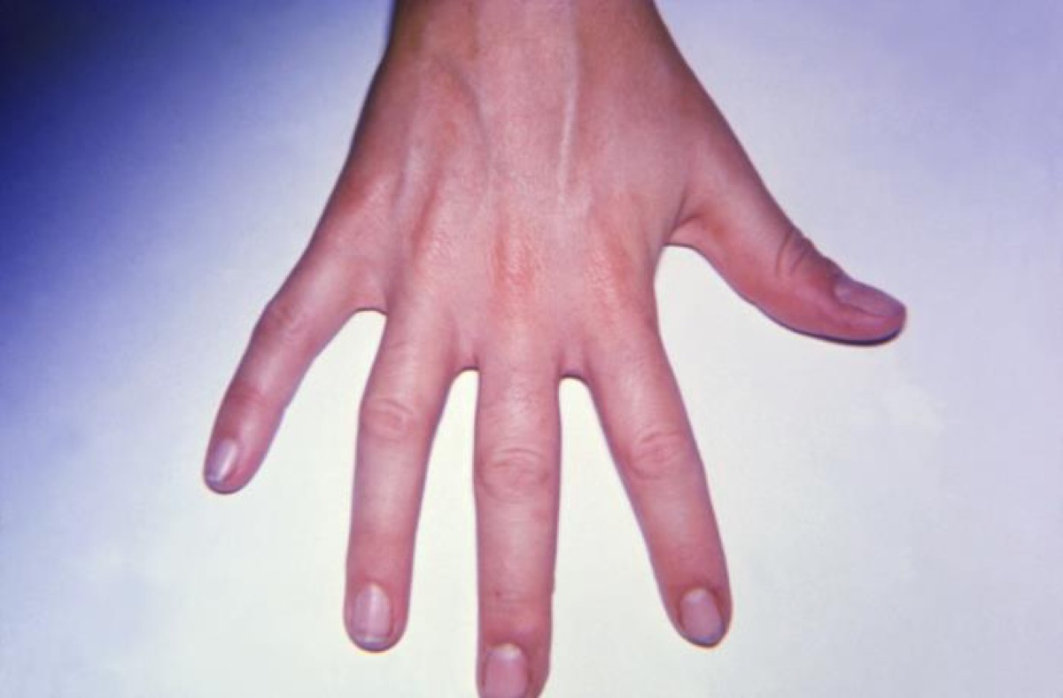 Close up of a hand affected by arthritis