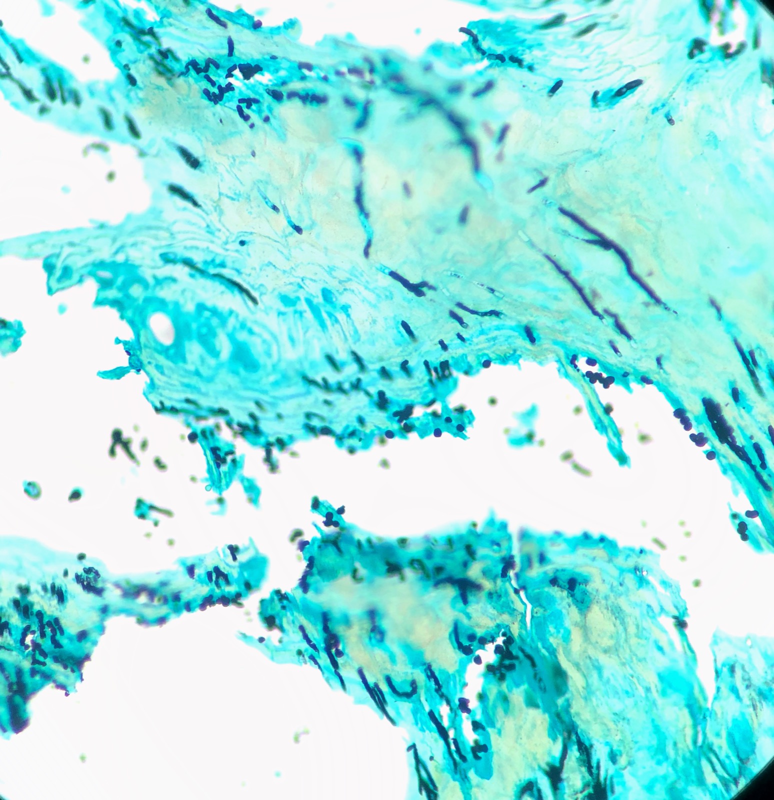 Microscope image showing fungal hyphae in a toenail sample