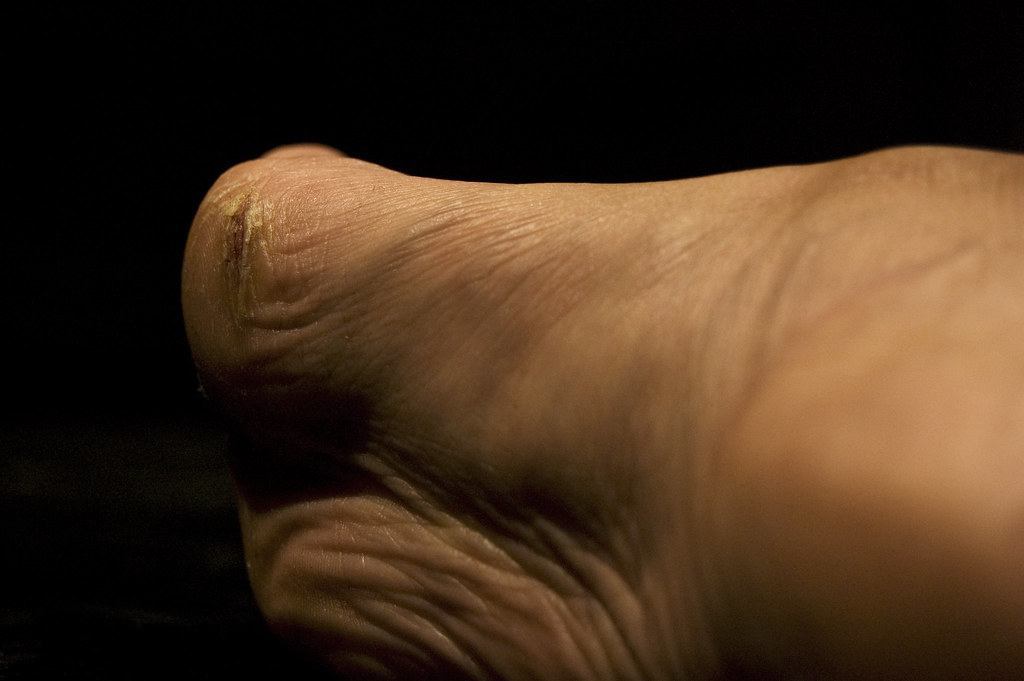 Close view of dry heel skin