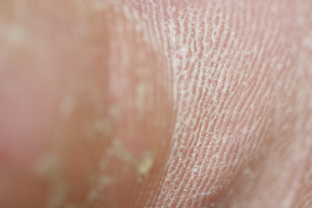 Close up of hard skin and callus texture on the sole of a foot