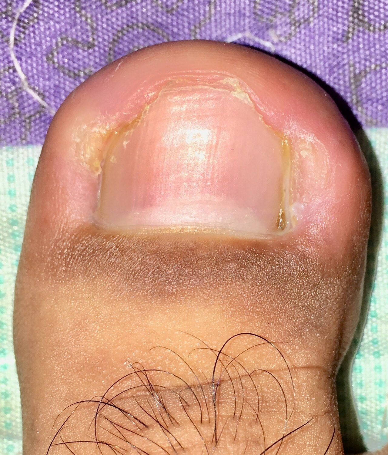 A close view of an ingrown toenail affecting the big toe