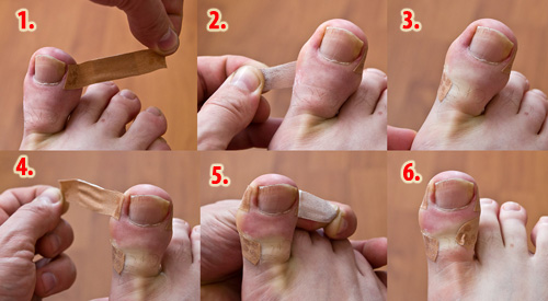 Close view of treatment for an ingrown toenail