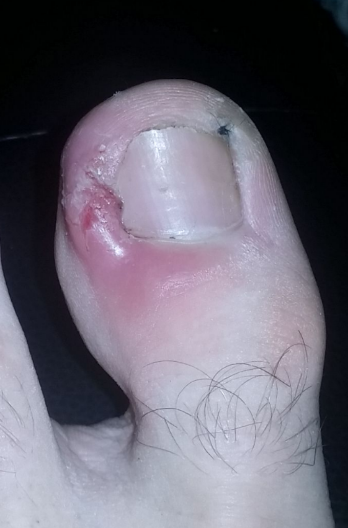 Illustration showing infection around the nail edge