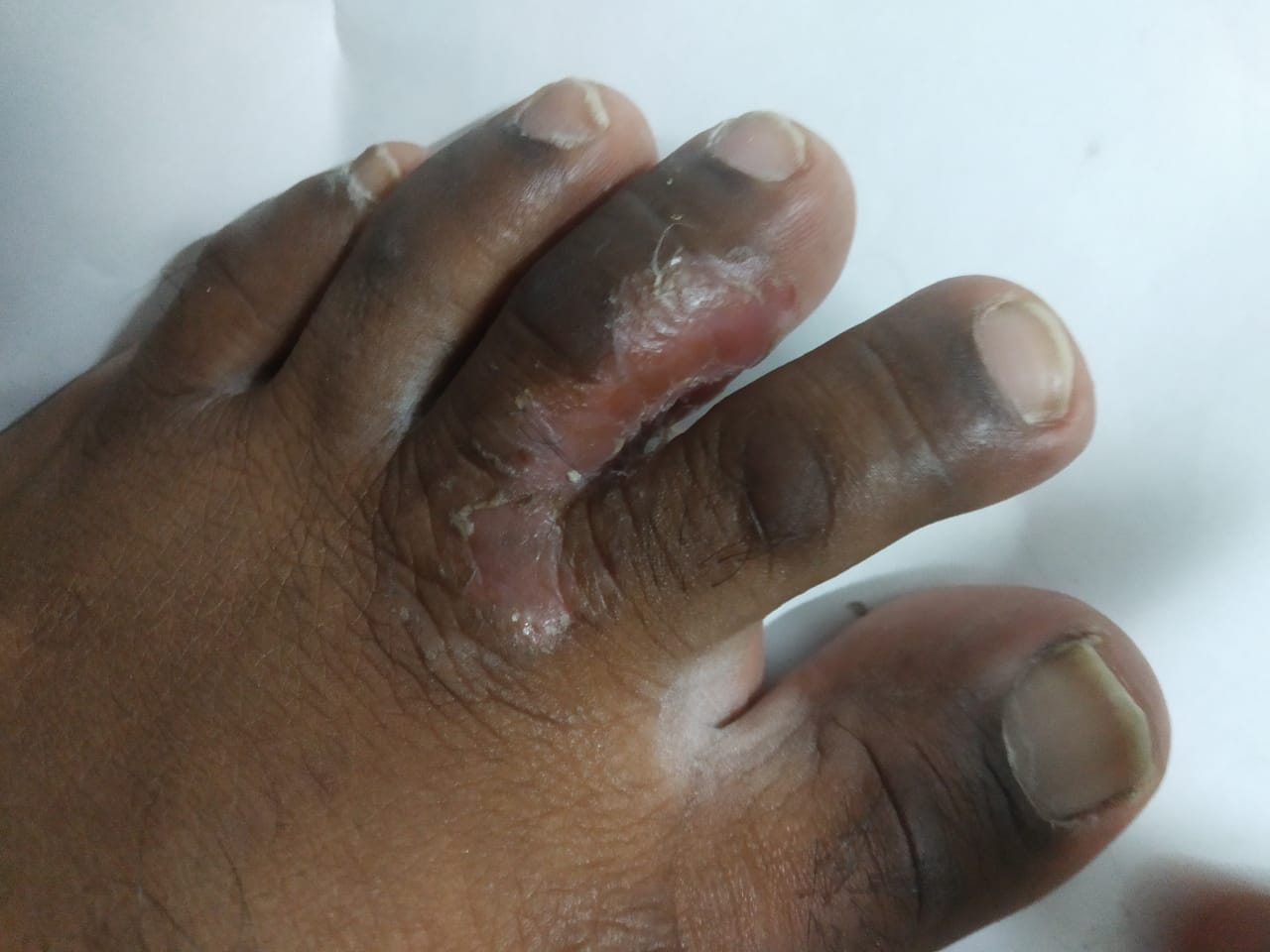 A close clinical view of athlete's foot affecting the skin around the toes