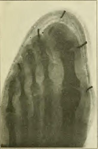 Illustration of a foot compressed by a narrow shoe shape