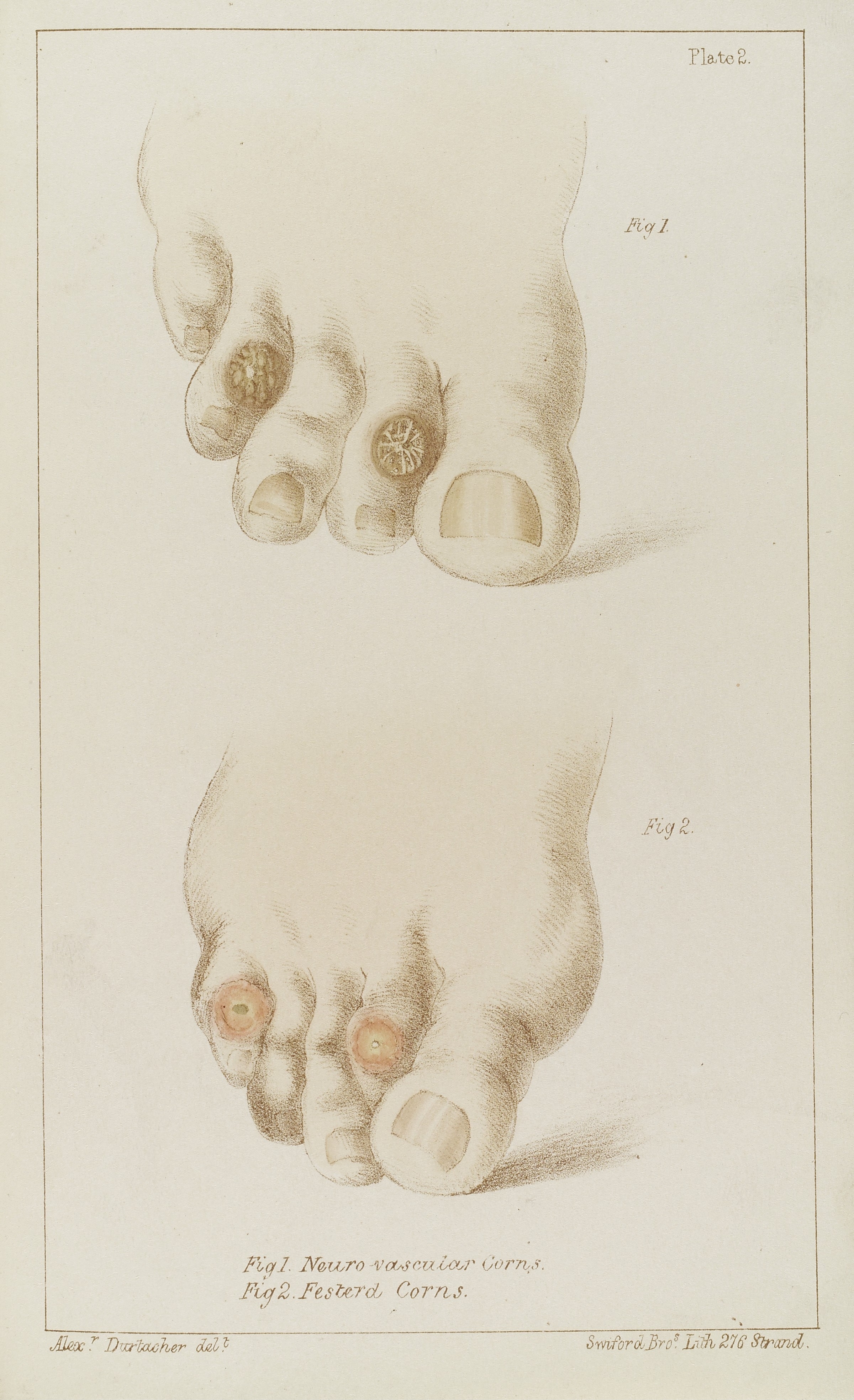 Medical illustration showing different types of corns on feet