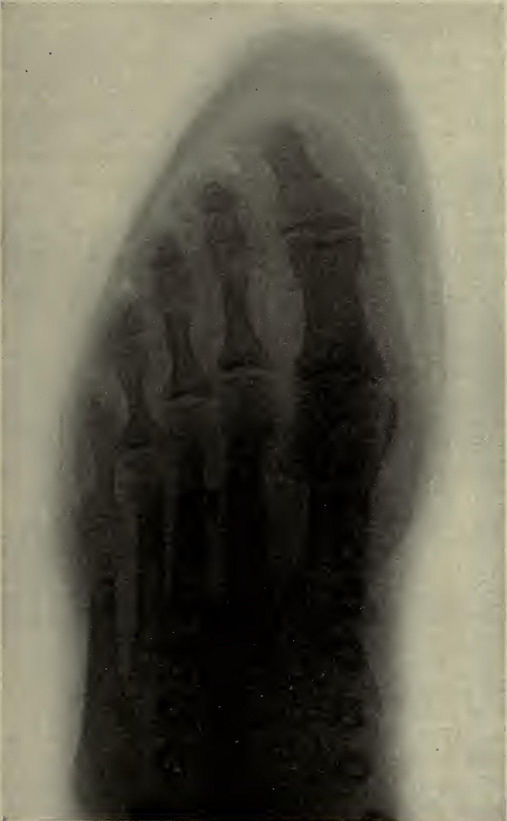 Historical shoe fitting image showing how a shoe can compress the front of the foot