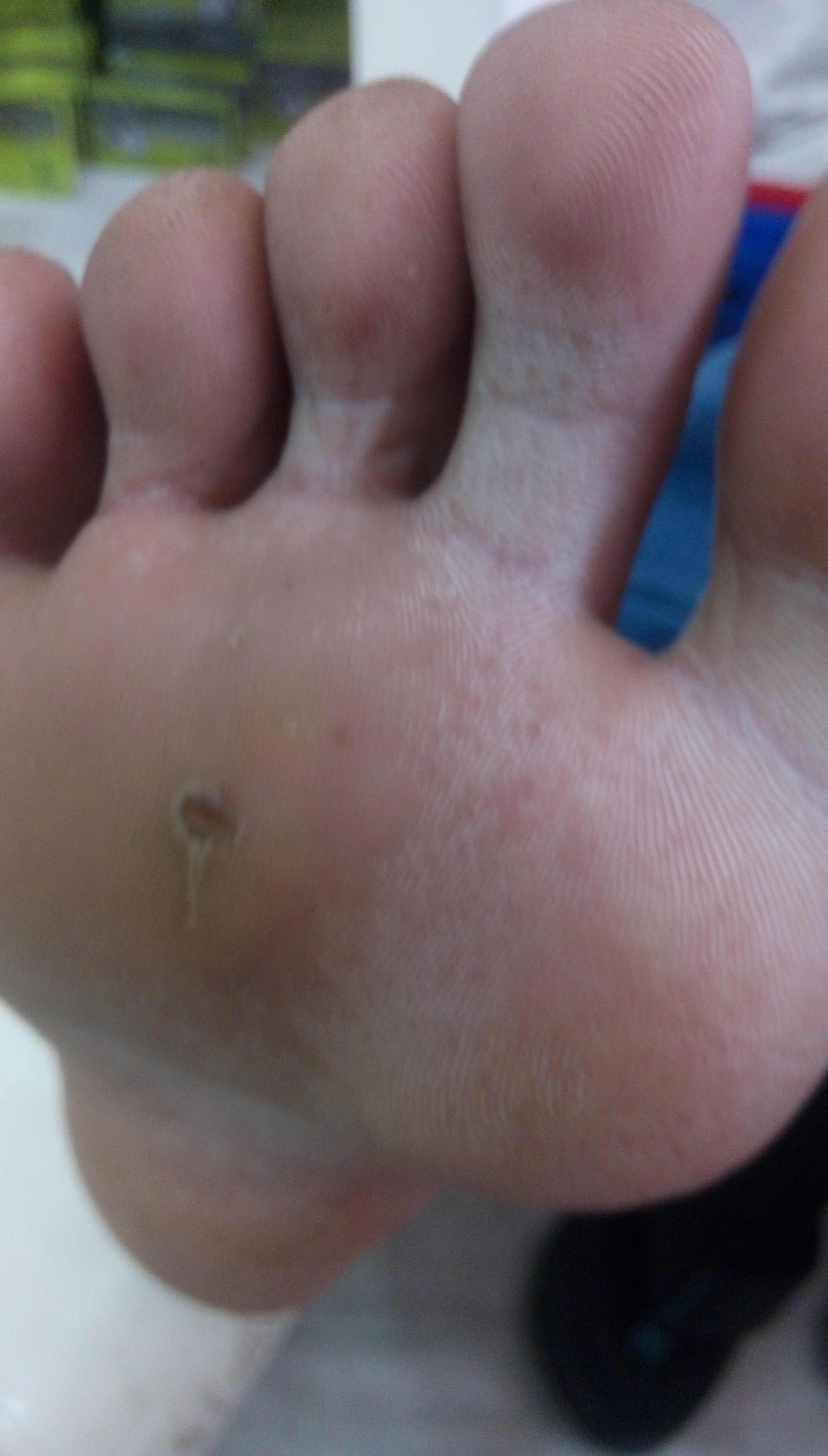 Close up of a small hard skin lesion on the sole of a foot
