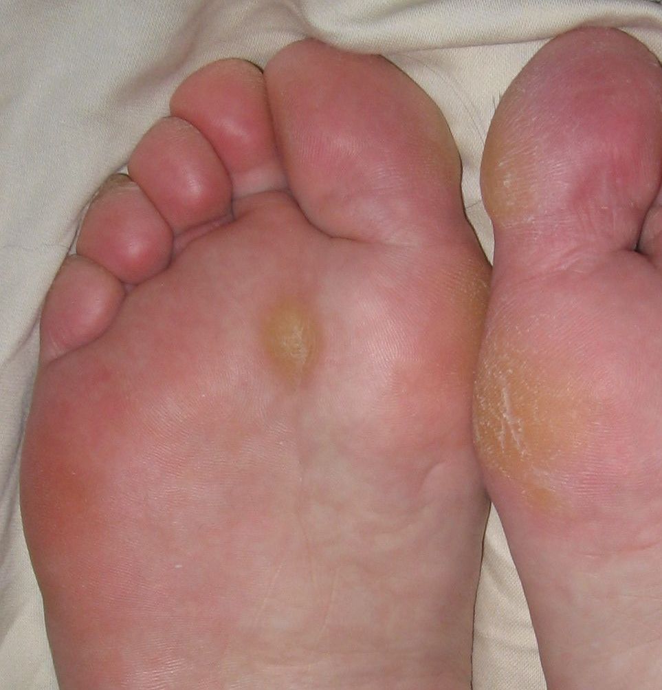 Close up of calluses on the sole of a foot