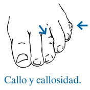Diagram showing common corn and callus pressure points on toes