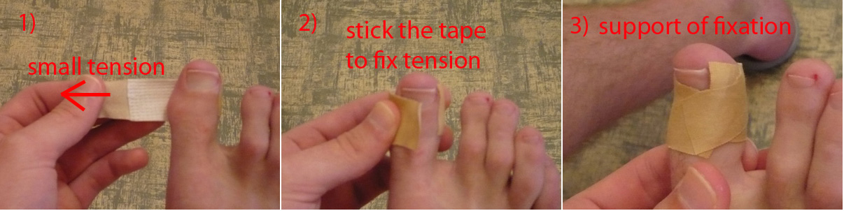 Close up of an ingrown toenail being relieved with a small taped skin fold