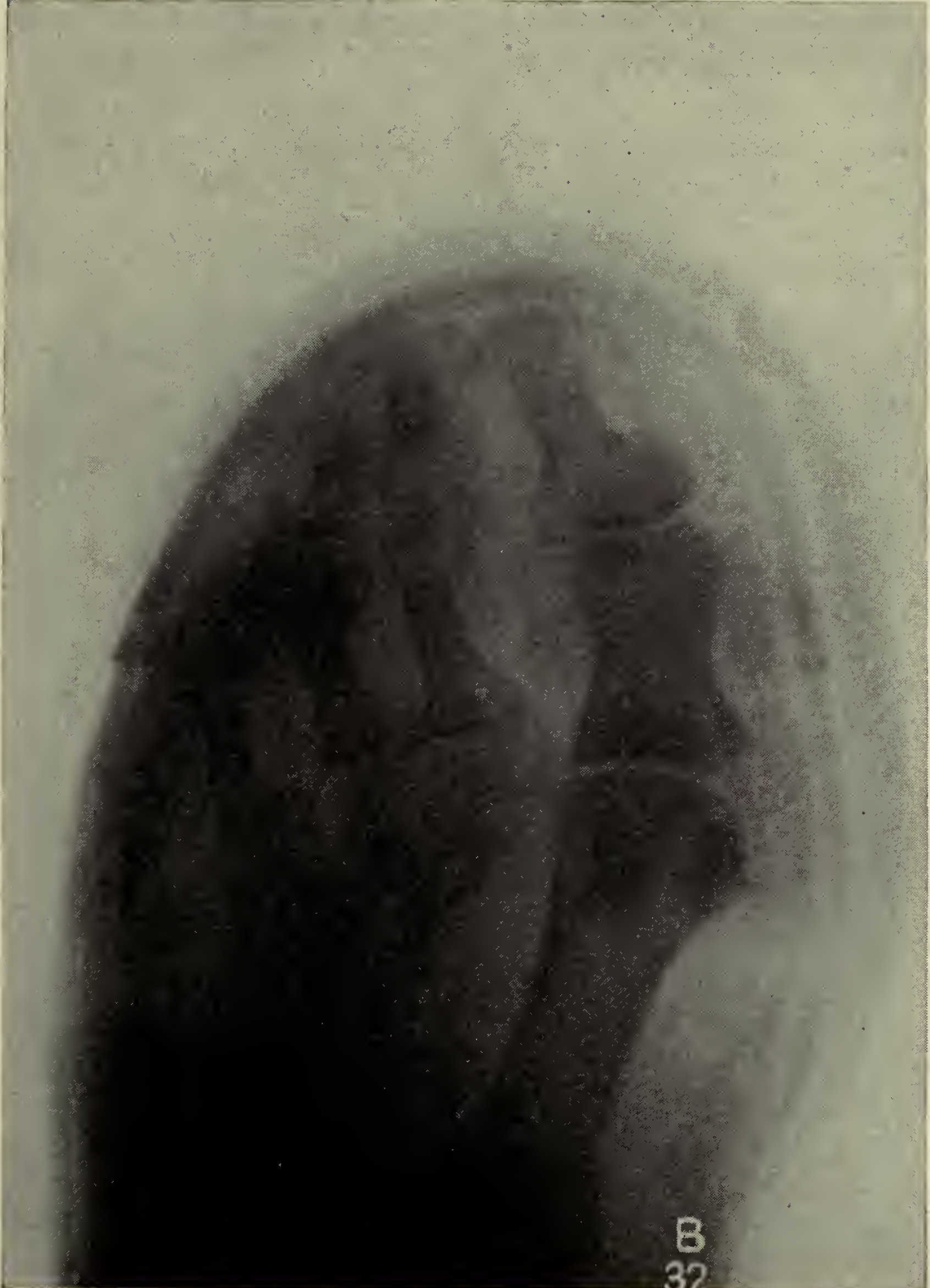 An old shoe fitting image showing pressure from a shoe that is too narrow