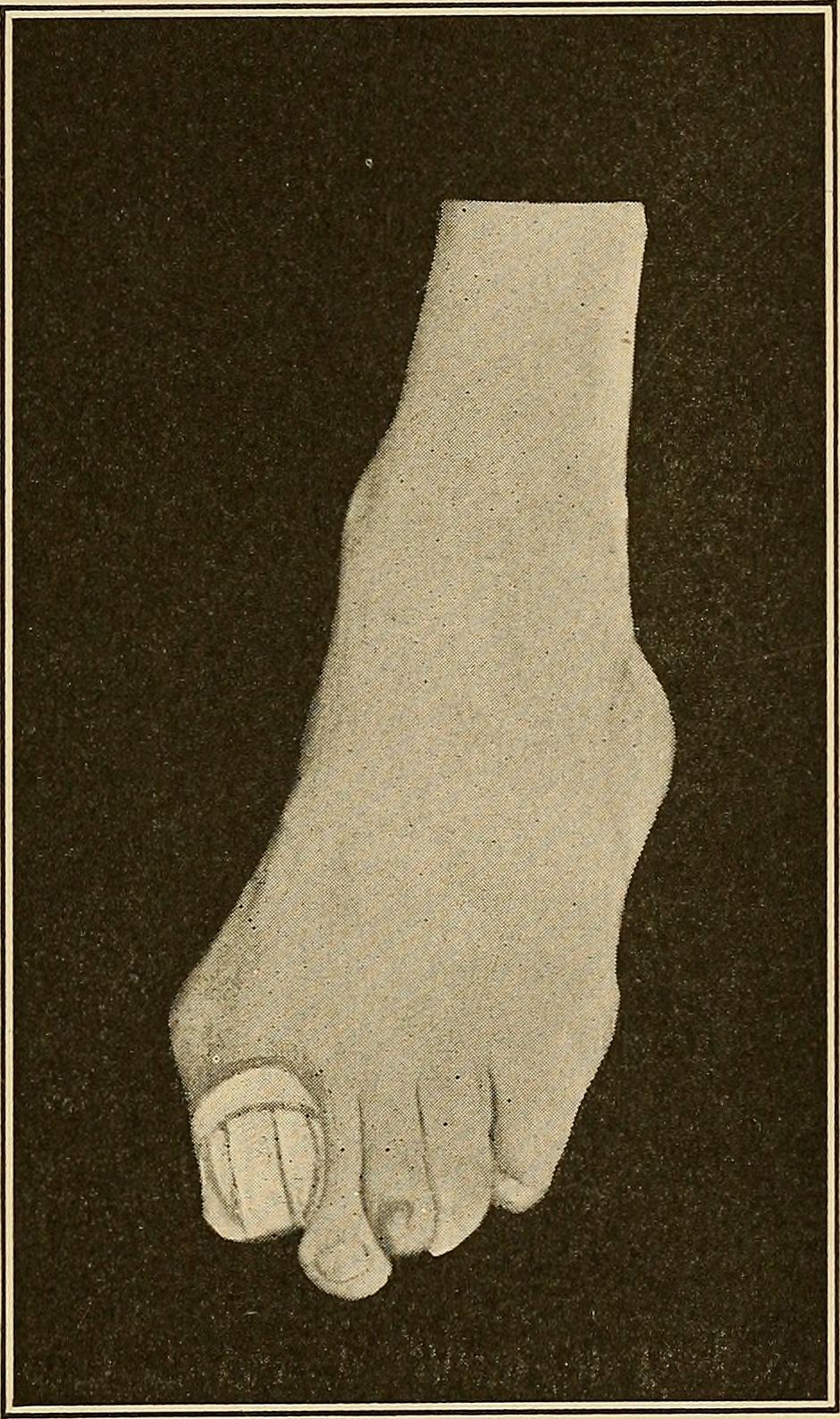 A historic podiatry treatment illustration showing foot care