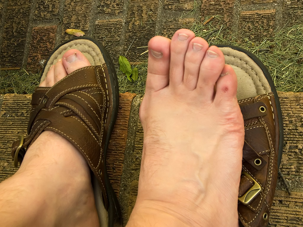 Feet in open footwear showing how shoe shape can affect pressure