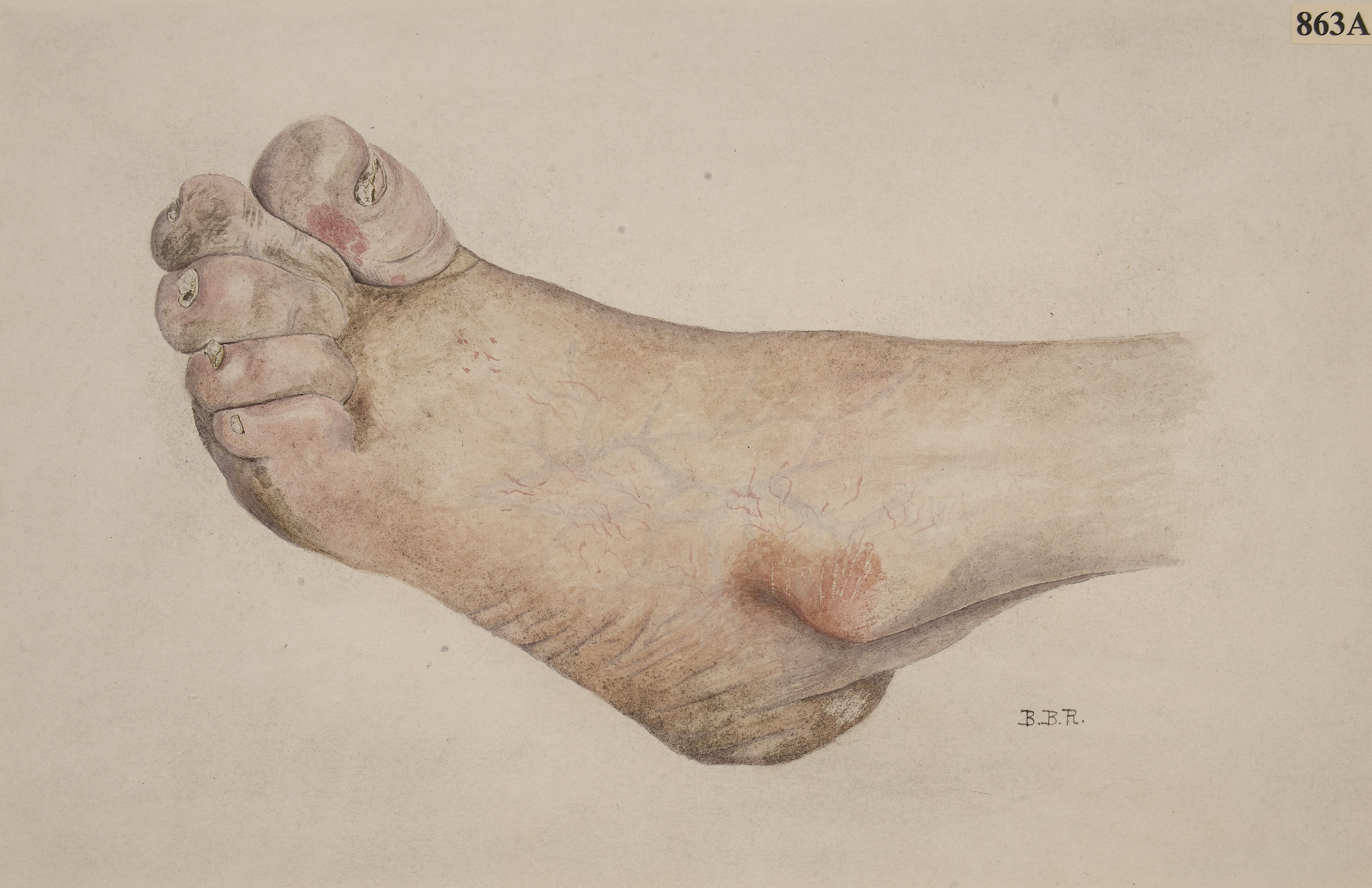 A close clinical photograph showing oedematous swelling of the toes