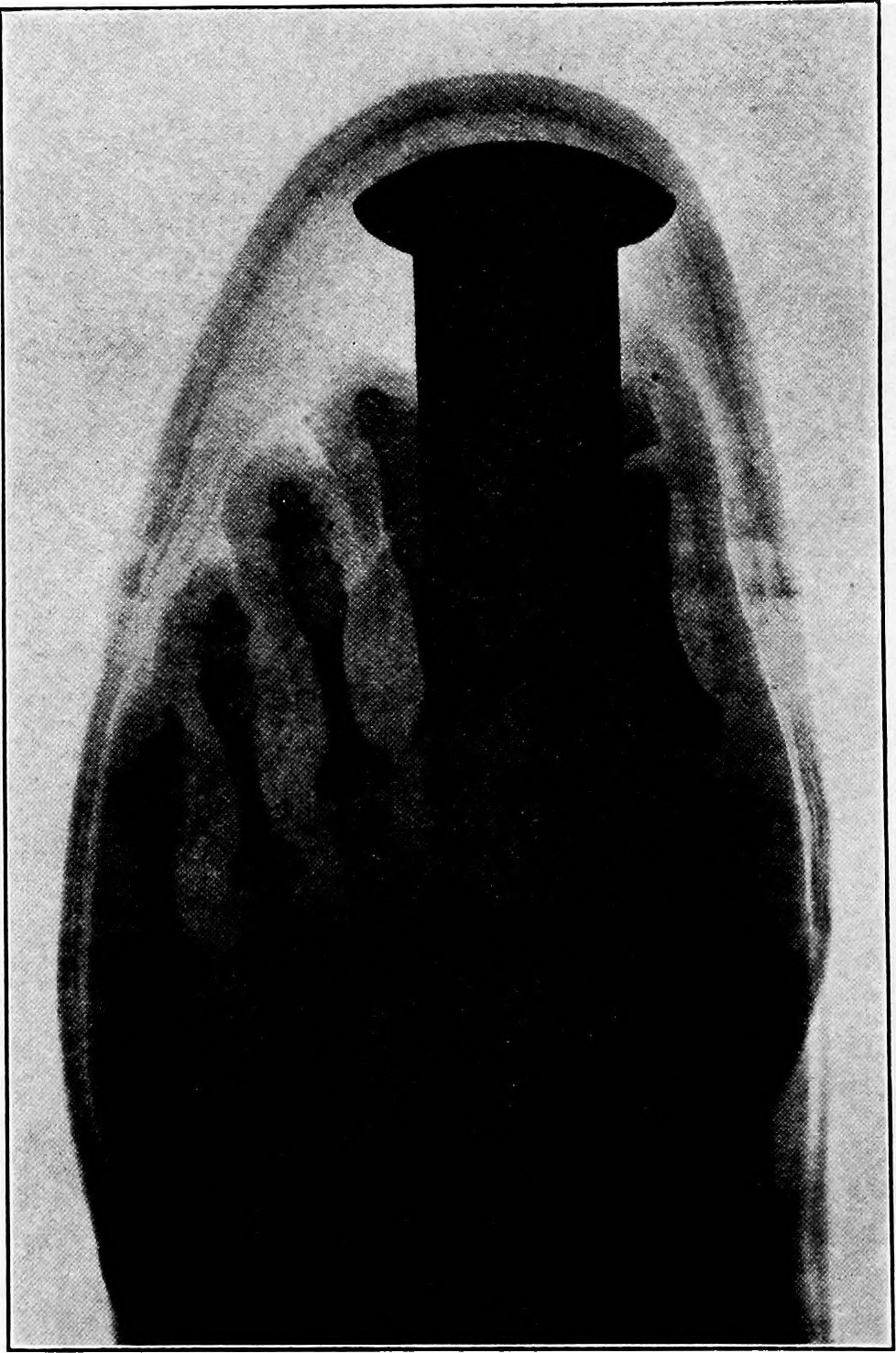 Foot in a shoe showing toe crowding and pressure