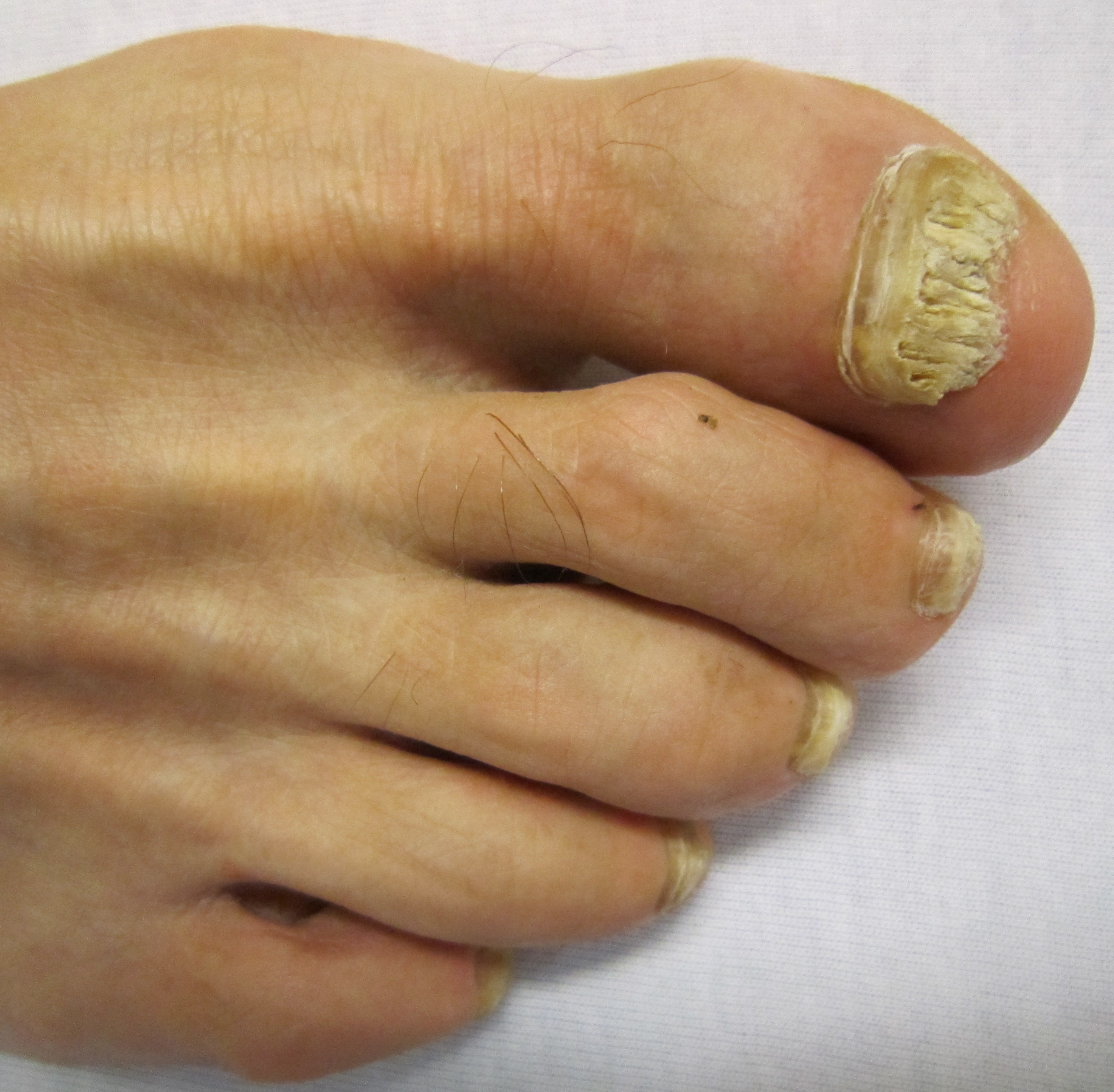 A yellow thick toenail being checked as a possible fungal nail problem